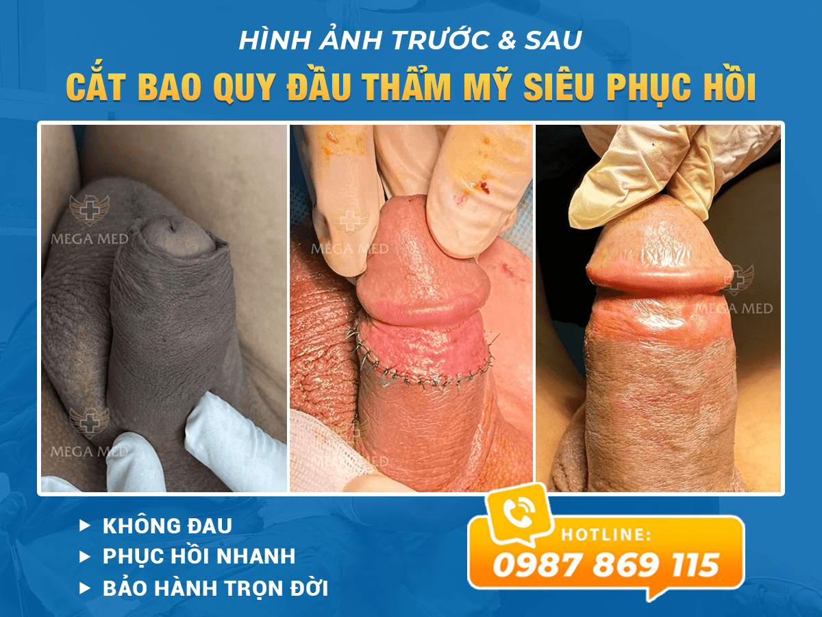 Cắt bao quy đầu thẩm mỹ siêu phục hồi